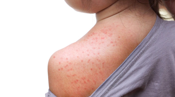 Masernfall in Liechtenstein