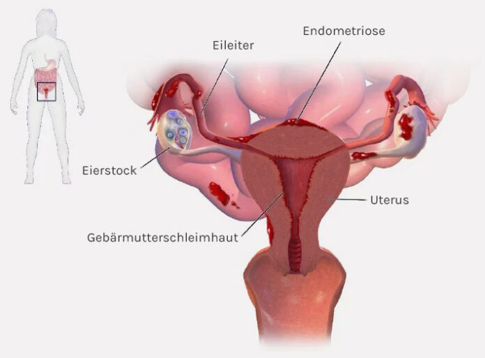 Endometriose, Abbildung Klinik Hirslanden